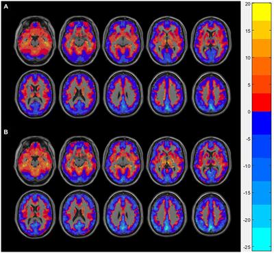 A voxel-level resting-state fMRI study on patients with alcohol use disorders based on a power spectrum slope analysis method